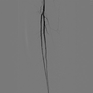 Digital subtraction angiography of the left popliteal artery and its tibial branches, demonstrating a hypoplastic posterior tibial artery.