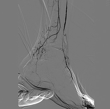 Digital subtraction angiography of the left pedal vessels.