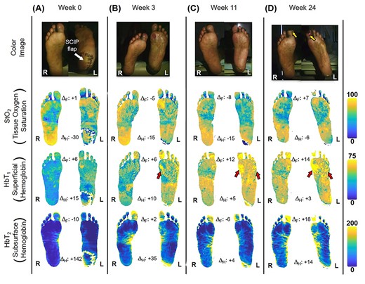 Quantitative longitudinal monitoring of plantar microvascular changes following SCIP flap reconstruction. SFDI-derived maps for StO2, HbT1 and HbT2 are shown at (A) Week 0, (B) Week 3, (C) Week 11 and (D) Week 24 following surgery. ΔF and ΔH denote bilateral differences (left–right) between forefoot (F) and heel (H) mean values. The yellow arrows indicate worsening gangrene at the halluces. Red arrows indicate regions with a blotchy distribution pattern.
