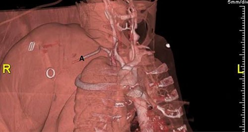 3D reconstruction of CT angiography showing abrupt cessation of flow beyond segment 1 of the right axillary artery (A).