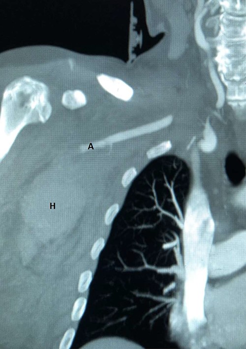 CT angiography reconstructed views demonstrating absent flow beyond segment 1 of the right axillary artery (A) with haematoma in the right axilla (H).