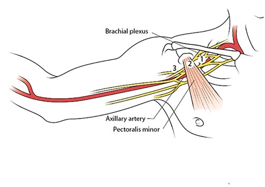 Illustration showing the three segments of the axillary artery as determined by the pectoralis minor muscle, which must be divided for complete exposure and safe control of the vessel. With permission from McMonagle MP. Vascular Trauma. In: Trauma: Code Red. Khan M, McMonagle MP, Nott D (Eds). CRC Press, Boca Raton, 2018.