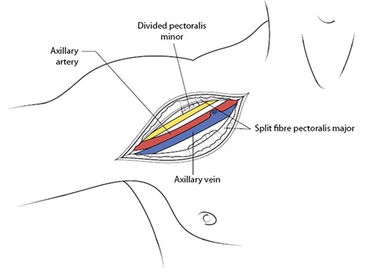 Once the pectoralis minor muscle has been divided, this brings into view the entire axillary artery along with the cords of the brachial plexus and its accompanying axillary vein (antero-posterior to the artery). With permission from McMonagle MP. Vascular Trauma. In: Trauma: Code Red. Khan M, McMonagle MP, Nott D (Eds). CRC Press, Boca Raton, 2018.