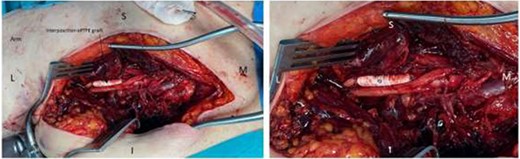 ePTFE synthetic graft (G) in situ. The medial cord of the brachial plexus is also seen as it becomes the median nerve (after receiving branch from lateral cord). The posterior cord is not visualised as it lies behind the graft. M = medial, L = lateral, S = superior, I = inferior.