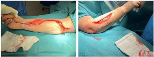 Forearm fasciotomy involving both volar (flexure compartment) and dorsal (extensor compartment) incisions. The volar incision releases the flexure compartment (the flexure muscles are more important for hand grip than the extensor muscles compartment). This is performed by starting at the medial aspect of the humerus (approximately where the brachial artery would be dissected ordinarily) and carried across the olecranon fossa as a transverse incision (to prevent a skin contracture) and then crossing the volar aspect of the forearm in a wavy pattern, crossing transversely at least once (to prevent a skin contracture). The incision is further carried across the wrist (and the flexure retinaculum is divided) taking care not to injure the median nerve here, and into the palmer fascia for about 2-3 cm (often following the line of the thenar eminence). The dorsal incision is a straight or slightly semi-lunar incision to release the extensor compartment.