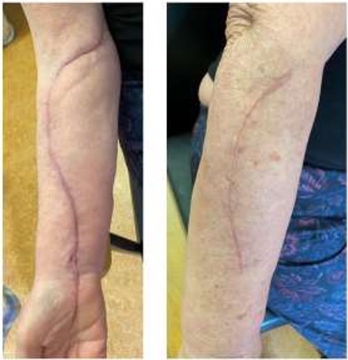 The forearm fasciotomy wounds went on to heal uneventfully.