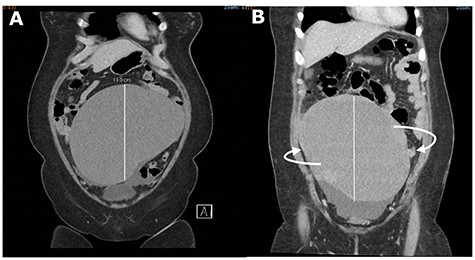 CT abdomen and pelvis (CTAP) showing acute change in orientation of the right ovarian mass before (A) and after (B) colonoscopy.