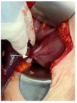Torsion of right ovarian pedicle seen intra-operatively.