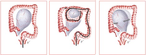 Illustration of looping precipitating ovarian torsion.