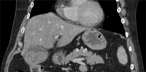 Coronal non-contrast CT of abdomen on day of presentation, showing hyperdense nodular soft tissue filling the gallbladder lumen.
