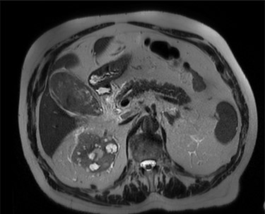 MRI scan of the patient, showing a distended gallbladder with low T1 and T2 content demonstrating no internal enhancement.