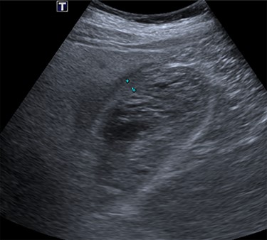 US scan of the patient, demonstrating a thick-walled gallbladder, with no evidence of calculi.
