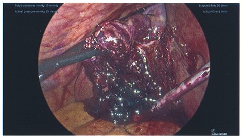 Photo taken intraoperatively, demonstrating haematoma leaking from a necrotic gallbladder.