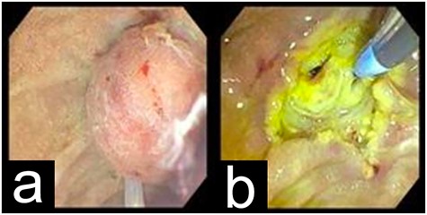 EGD showing the periampullary mass before (a) and after (b) resection.