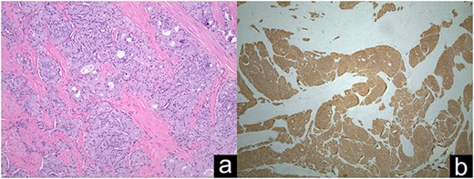 Ampullary well-differentiated, low-grade (G1) neuroendocrine tumor (a); Synaptophysin staining in immunohistochemistry (b).
