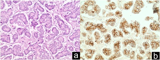 Distal NET metastasis to umbilical hernia sac discovered intraoperatively (a); CD56 staining in immunohistochemistry (b).