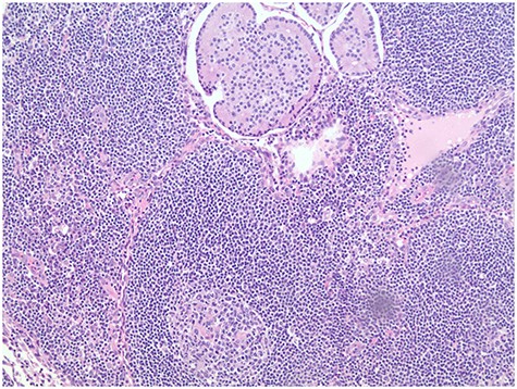 Peripancreatic lymph node metastasis of NET.