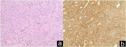 GIST discovered incidentally intraoperatively (a); DOG1 staining in immunohistochemistry (b).