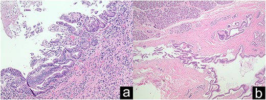 Grade 1–2 PIN at the pancreatic neck margin (a); Low power view of main duct IPMN (b).