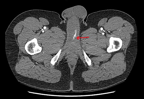CTA demonstrating an axial view of contrast enhancement within the region of the left cavernosal artery, indicative of an arterial pseudoaneurysm (red arrow).