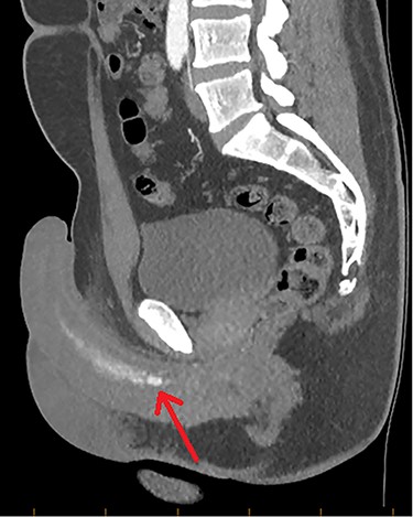 CTA demonstrating a sagittal view of contrast enhancement within the region of the left cavernosal artery and mid-to-distal corpus cavernosum (red arrow).