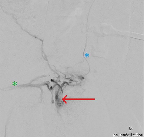 DSA via superselective cannulation of the left (blue asterix) and right (green asterix) distal branches of bilateral internal pudendal arteries; note the arterial pseudoaneurysm (red arrow) pre-embolization.