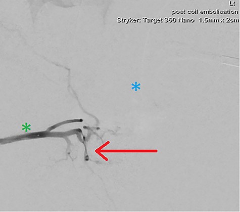 DSA demonstrating significantly reduced flow into the cavernosal artery pseudoaneurysm post-coil embolization (red arrow); note the left (blue asterix) and right (green asterix) distal branches of bilateral internal pudendal arteries for reference.