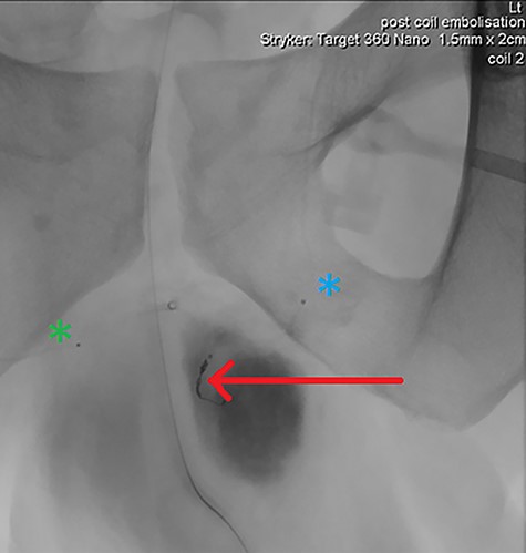 Final intraoperative fluoroscopic image demonstrating microcoil placement (red arrow); note the microcatheter placement within the left (blue asterix) and right (green asterix) distal branches of bilateral internal pudendal arteries for reference