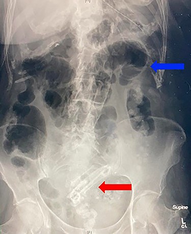 Abdominal X-ray demonstrating projection of biliary stents in the pelvis (red arrow) and multiple air fluid levels suggestive of a small bowel obstruction (blue arrow).