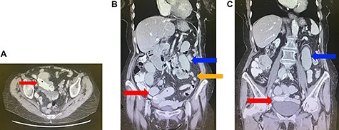 (A) Axial view of computed tomography (CT) of the abdomen demonstrating migration of the biliary stents into the small bowel (red arrow). (B) Coronal view of CT of the abdomen demonstrating migration of the biliary stents into the small bowel (red arrow), with dilated (blue arrow) and collapsed (orange arrow) loops of small bowel suggestive of a small bowel obstruction. (C) Coronal view of CT of the abdomen demonstrating migration of the biliary stents into the small bowel (red arrow) and dilated loops of small bowel (blue arrow).