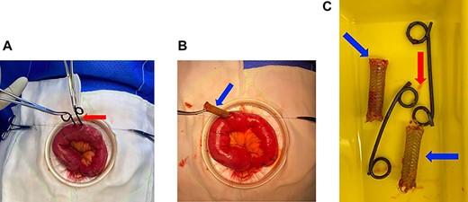 (A) Enterotomy in proximal ileum demonstrating removal of two plastic pigtail stents (red arrow). (B) Enterotomy in proximal ileum demonstrating removal of a covered metal stent (blue arrow). (C) Stents post removal, two plastic pigtail stents (red arrow) and two covered metal stents (blue arrows).