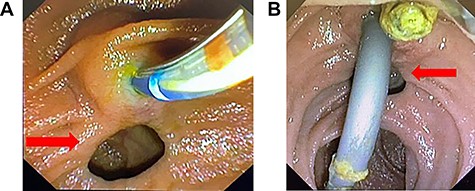 (A) ERCP images demonstrating the duodenal diverticulae (red arrow) at the site of the major duodenal papillae. (B) ERCP images demonstrating the duodenal diverticulae (red arrow) at the site of the major duodenal papillae.
