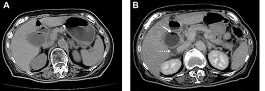 On admission, abdominal computed tomography (CT) scan showed a gas-fluid level in the gallbladder and surrounding fatty infiltration with ascites (A). On hospital day 2, abdominal CT revealed increased gas within the gallbladder (B, white arrow) and the development of pericholecystic fluid (B, dot arrow).