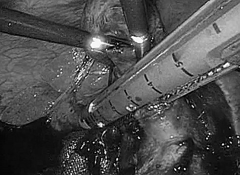 Intraoperative photograph. Significant adhesions and severe infiltration were encountered intraoperatively. The cystic duct and gallbladder artery were treated collectively by an automatic anastomotic device.