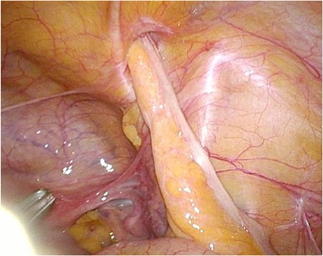 Laparoscopic view of a non-pathological appendix entering the femoral canal.