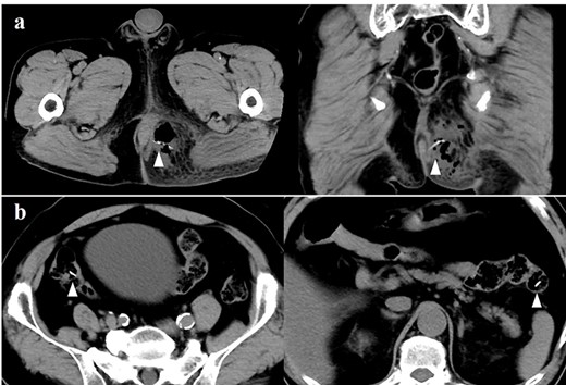 (a) A computed tomography scan showing the perianal abscess cavity containing air in the left-side buttock. The arrow indicates the fish bone in the abscess cavity. (b) Several high-intensity structures (white arrow) suspected as fish bone in the gastrointestinal tract.