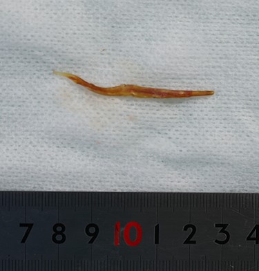 The 5 cm fish bone removed from the abscess cavity.