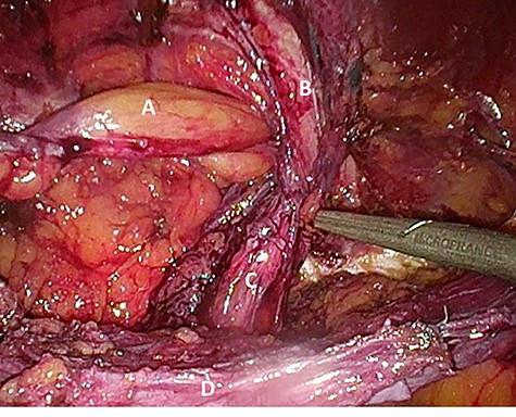 Suspected indirect inguinal recurrence hernia with a large spermatic cord lipoma (A), epigastric vessels (B), ductus deferens (C), peritoneum with previous mesh (D).