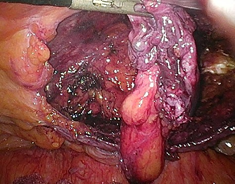 Dissection of the large spermatic cord lipoma with attached fibrotic tissue.