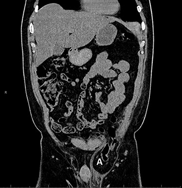 Computed tomography with sigmoid colon and solid tissue in hernia sac (A).