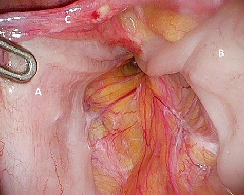 ‘Loop’ of sigmoid colon in left inguinal canal (afferent loop: A; efferent loop: B; peritoneum: C).