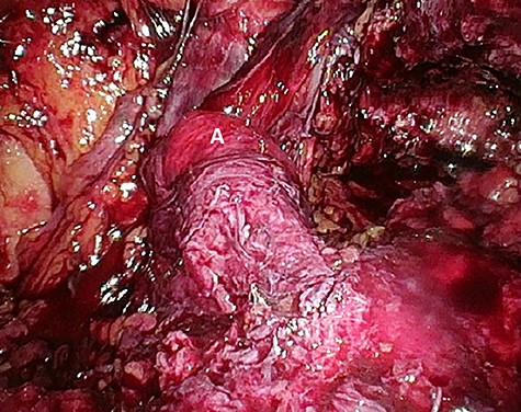 Preperitoneal view of the large hernia sac (A) ‘hidden’ in the scar tissue.