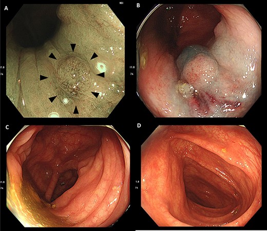 (A) Endoscopic findings indicated Isp-type lesions in the lower rectum (arrowhead). (B) It was difficult to secure adequate margins by snaring during endoscopic mucosal resection due to contact with the dentate line. (C and D) There were no findings of cancer in ascending colon.