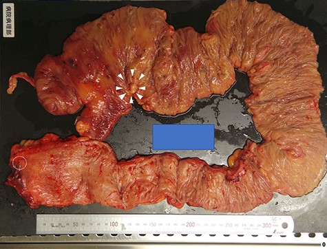 The resected specimen shows a 15 × 14 mm Ip lesion that was found in the ascending colon (arrow head), and a 5 mm-sized elevated lesion was observed in the lower rectum (dotted line circle): it is difficult to recognize with the naked eye.