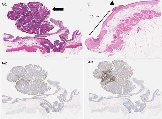 (A-1) Histopathological findings. A 15 × 14 mm Ip lesion was found in the ascending colon, and a well-differentiated tubular adenocarcinoma showing moderate atypia was found in the tubular lineage (arrow). (A-2) Ki-67 was highly positive, whereas p53 was strongly positive in a diffuse manner. (A-3) p53 was weakly positive in a mosaic pattern and in the cancerous component. (B) In the lower rectum, a 5 mm-sized elevated lesion was observed, and a low-grade dysplasia-equivalent image showing moderate atypia was also obtained (arrowhead). The resected margin, which was 11 mm in size, was negative.