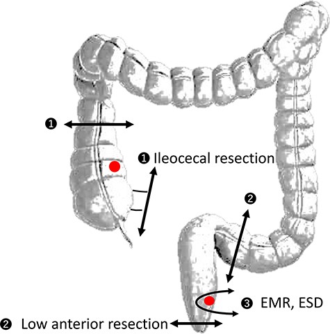 Potential problems of segmental colectomy and endoscopic treatment ❶ Metachronous cancer after ileocecal resection: small intestine and mesentery adhesions to the right retroperitoneum that make creating the pouch and reaching the anus difficult❷ Metachronous cancer after low anterior resection makes future pouch surgery difficult owing to adhesion or pelvic infection❸ Postendoscopic mucosal resection (EMR) or endoscopic submucosal dissection (ESD) in the surgical anal canal These procedures lead to surgical anal canal fibrosis and stenosis, and surgeons may encounter difficulties with mucosectomy and insertion of the circular stapler.