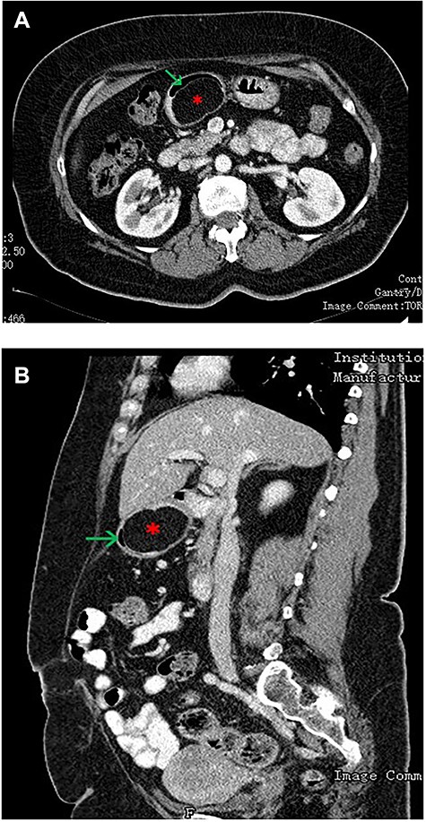 (A—coronal plane; B—sagittal plane): CT scan of the abdomen showing a large well-encapsulated and fat-attenuated submucosal lesion (8 × 3 cm) in the posterior wall of the gastric antrum, which causes lumen obstruction (*gastric lipoma, arrow—gastric lumen).