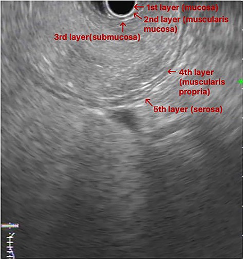 EUS image: homogeneous and hyperechoic lesion in submucosa layer.