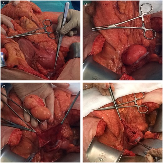 Intraoperative photos (A—mass-effect of the gastric lipoma; B—lipoma in the lumen of the stomach after anterior gastrotomy (slight mucosa ulceration); C—enucleated gastric lipoma (open mucosa); D—Sutured posterior wall mucosa after enucleation).