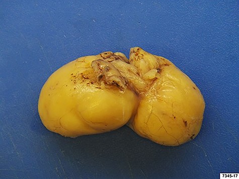Surgical specimen: gastric lipoma with dimension of 80 × 35 × 35 mm.